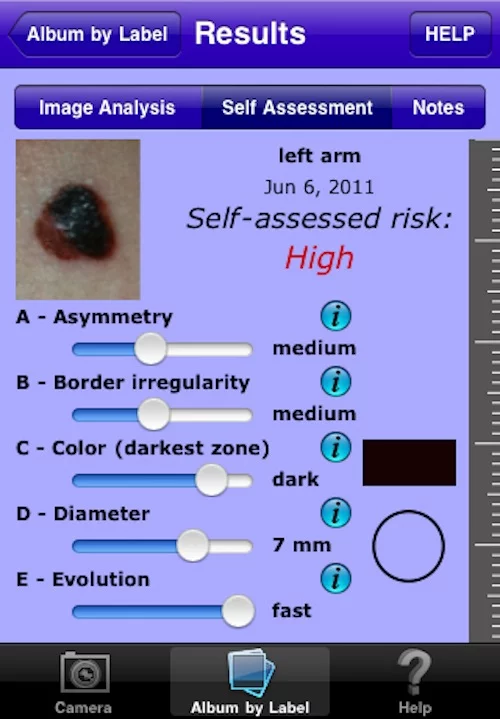 MelApp uses mathematical algorithms and image based pattern recognition technology to analyze the uploaded image