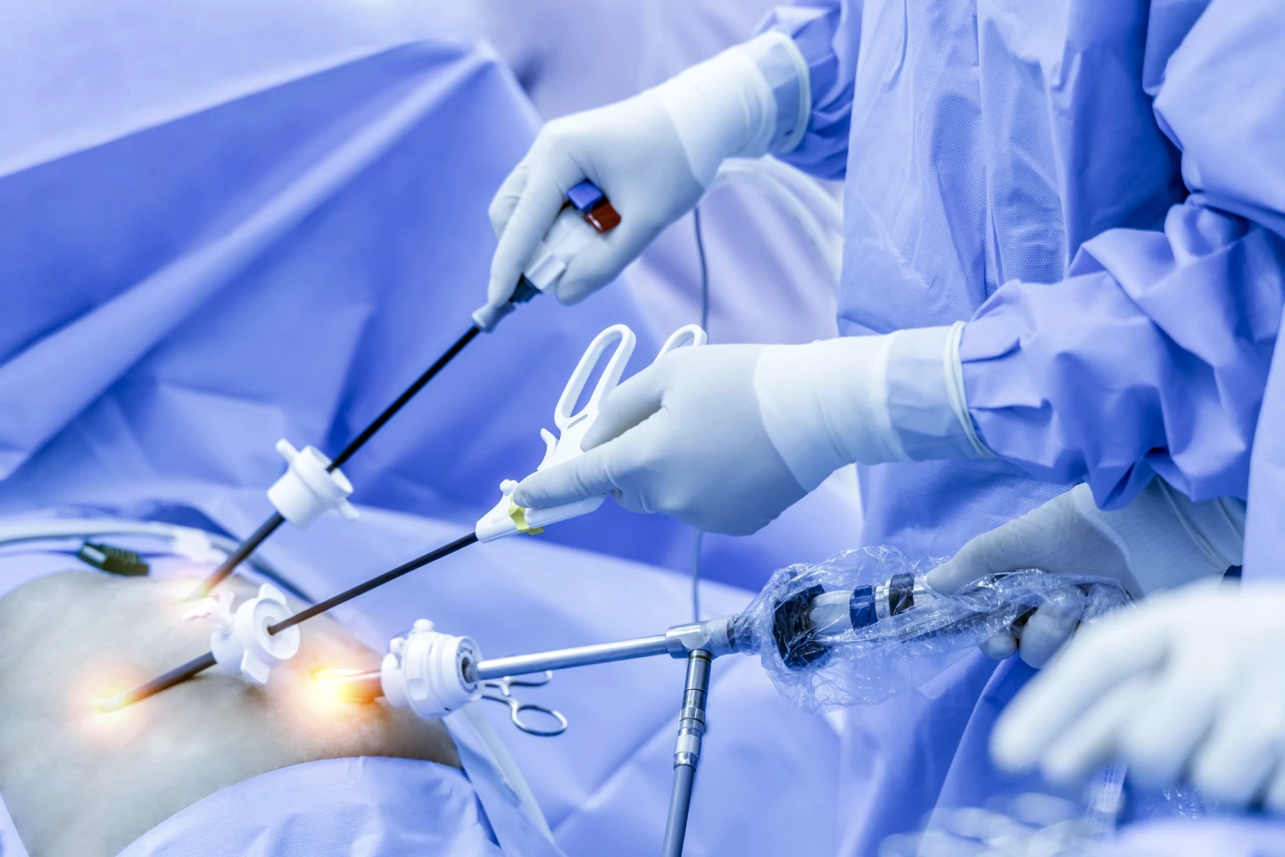 Bariatric surgical procedures can be done via a laparoscope