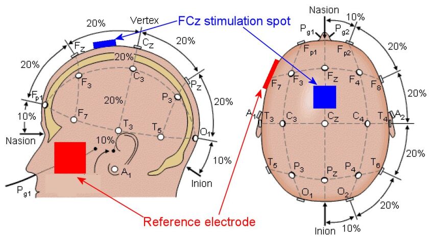 The electrode placement positions for the Vanderbilt study (Image: modified by Author)