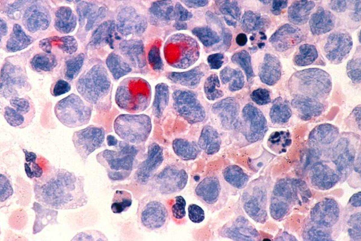 Leukemia Survival Rate: Amazing Curable Facts for Kids