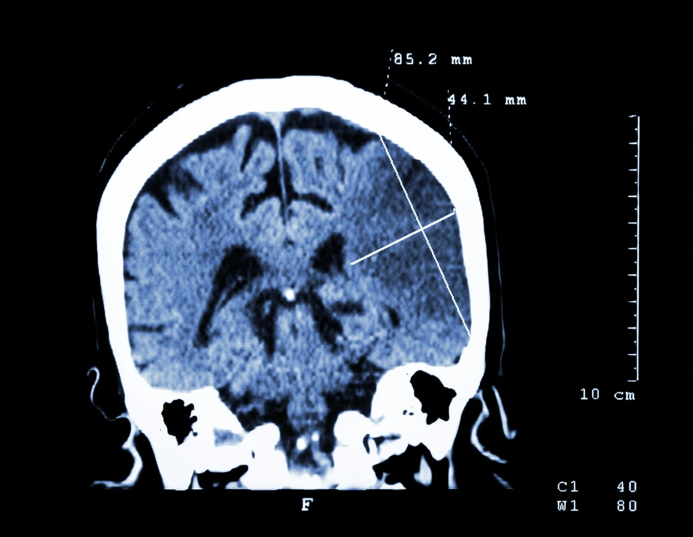 A drug already used to treat certain conditions in humans can not only limit the effects of stroke, but also help repair the damage they cause