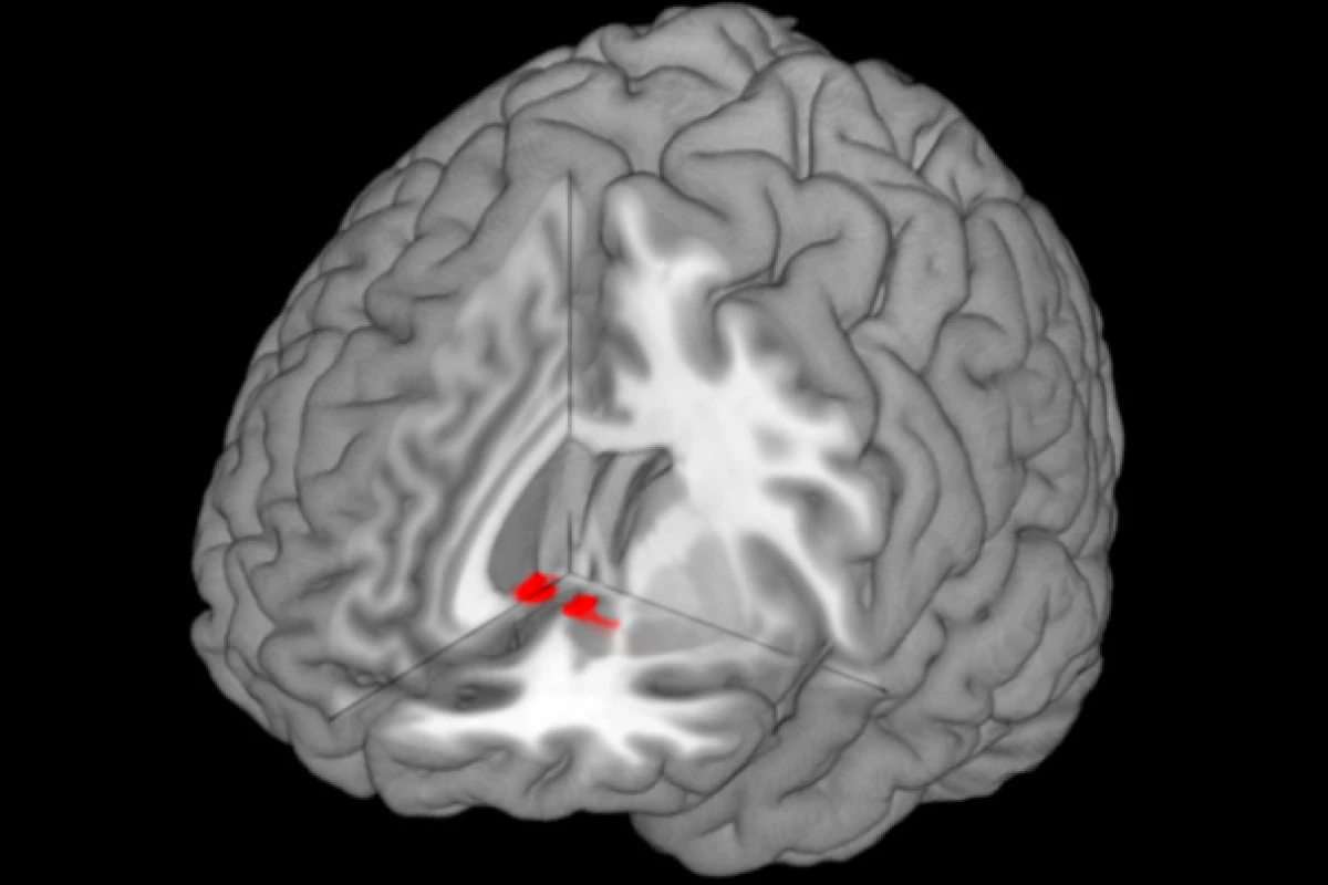 Close neurological ties between reward-processing and pain-processing regions in the brain may allow love to provide effective pain relief (Image: Chris Rorden, rendered with MRIcroGL)