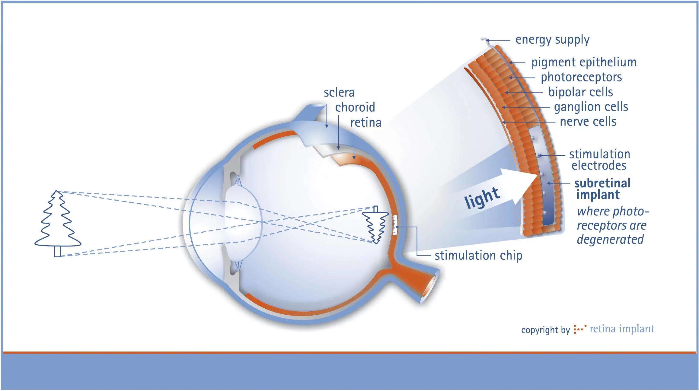 Detail cross section of implant in retina layers (Image: Retinal Implant AG)