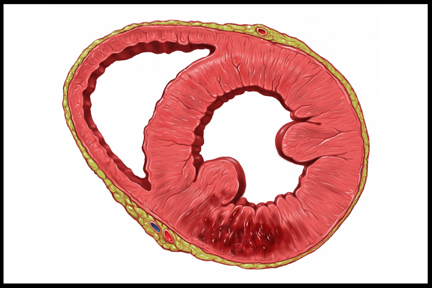 Area of tissue damage following a heart attack