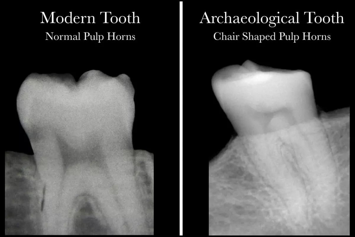 A modern healthy tooth with pulp "horns" (left), and an archeological tooth indicating a lack of vitamin D