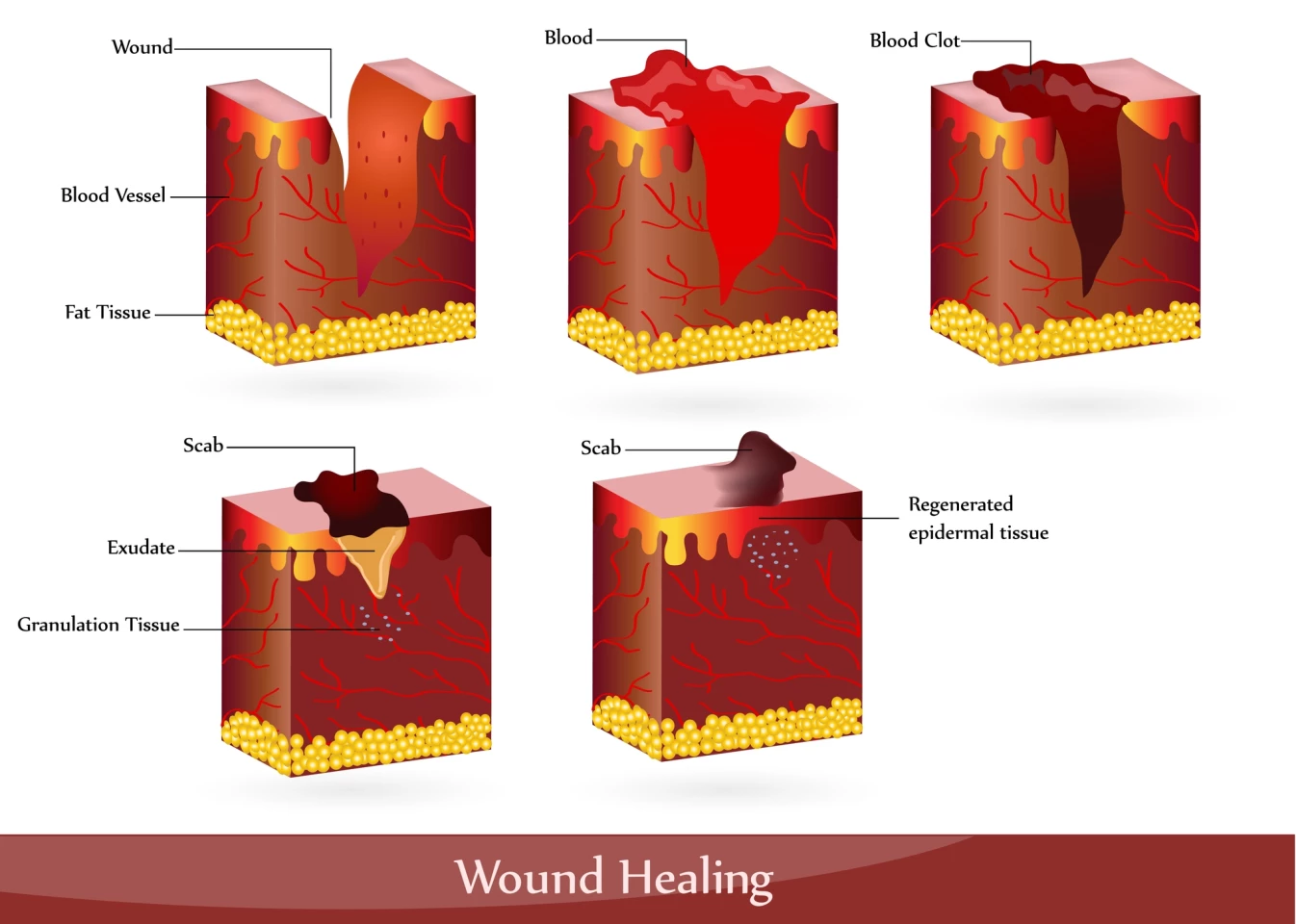 Stages of wound healing
