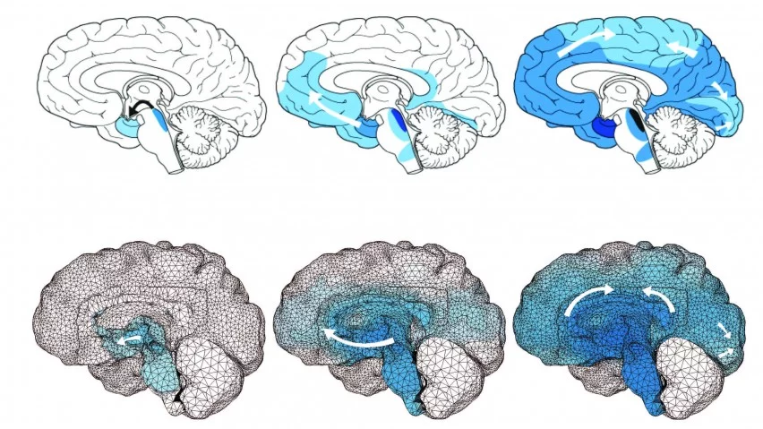 The above model shows how toxic tau proteins spread throughout the brains of patients with Alzheimer's disease