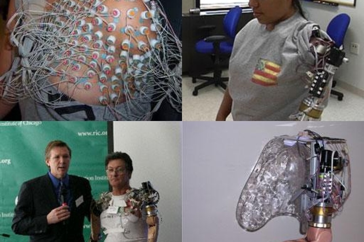 First Bionic Arm fitted to a female patient