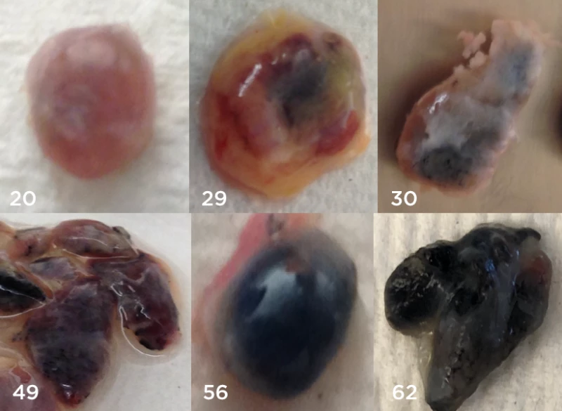 Lung lymph nodes from six non-smokers between the ages of 20 and 62. Particles of air pollution darken the lymph nodes and impair immune cells within the nodes.