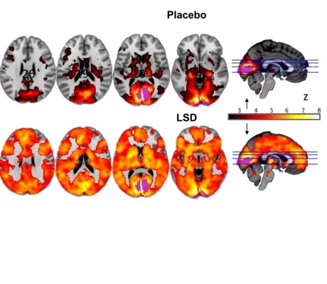 This image shows how, with eyes-closed, much more ofthe brain contributes to the visual experience underLSD than under placebo