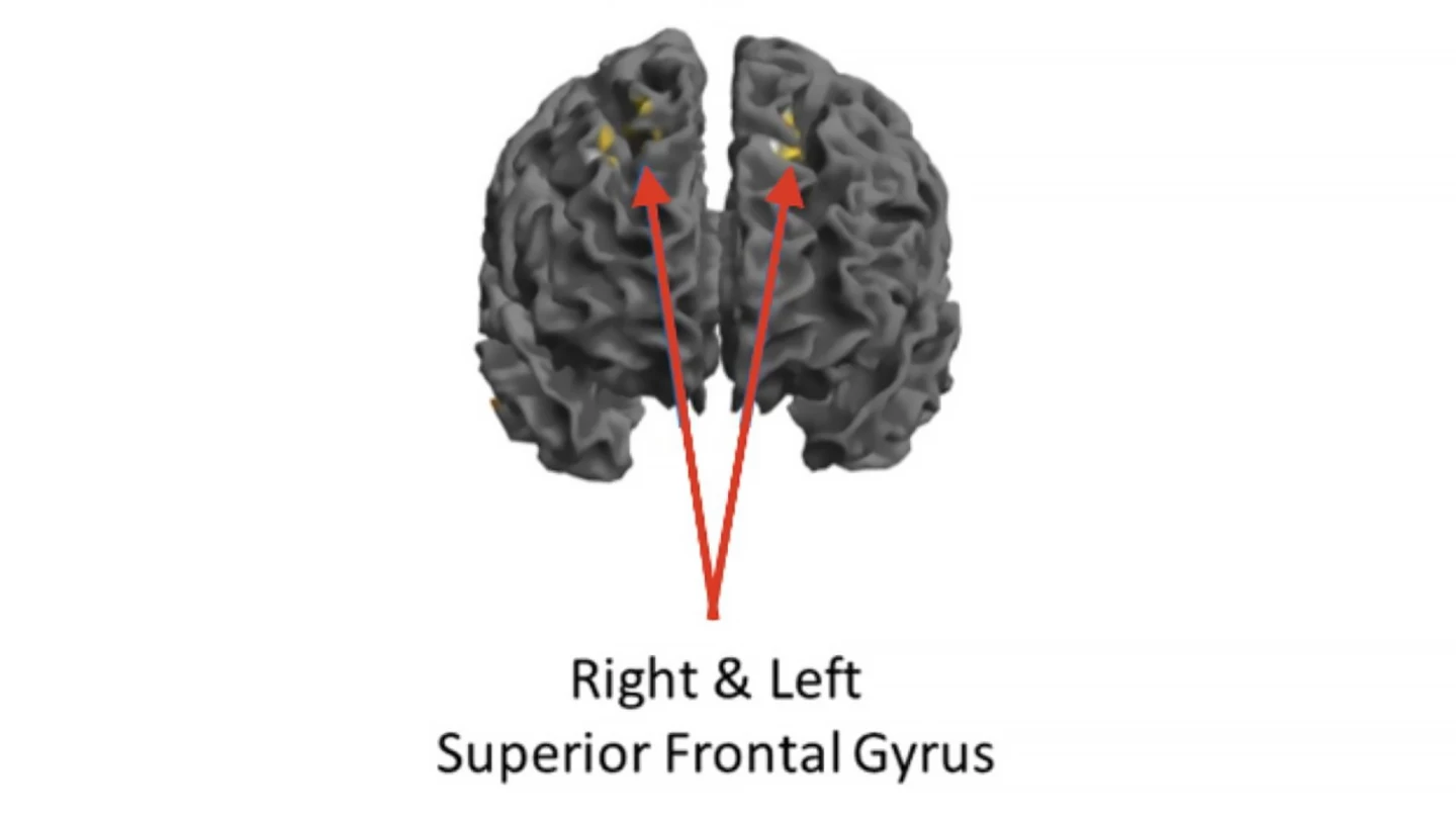 Front view of the brain. The jazz musicians showed reduced activity in these frontal-lobe areas when in a high-flow state