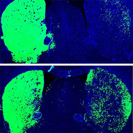 Mouse brain seen before (top) and after a single gene treatment, where astrocytes were converted into more dopaminergic neurons (seen in green)