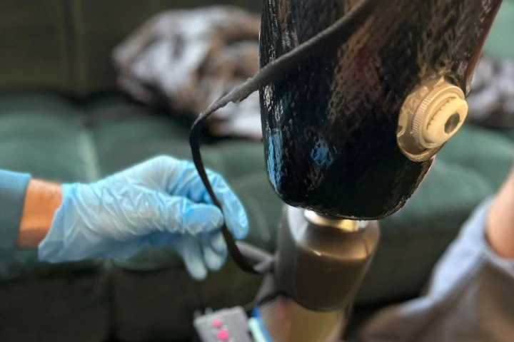 The new Roliner material is tested in the socket of a prosthetic leg
