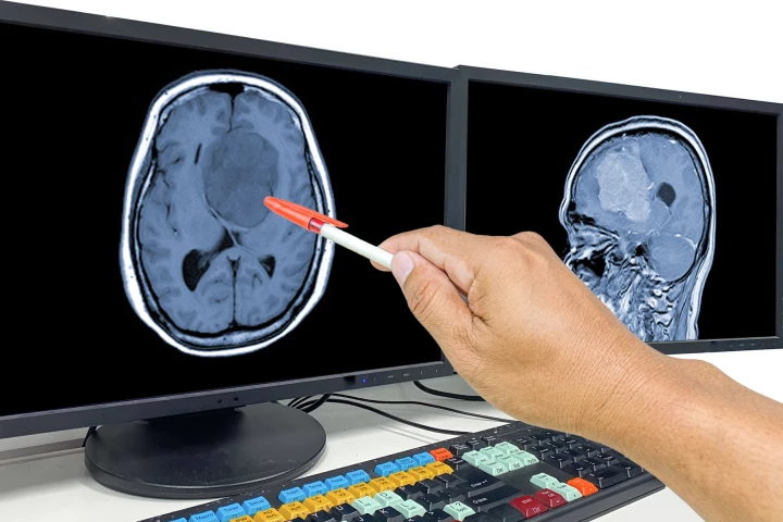 A new study has found that using a combination of therapies is more effective against glioblastoma, an aggressive and deadly form of brain cancer