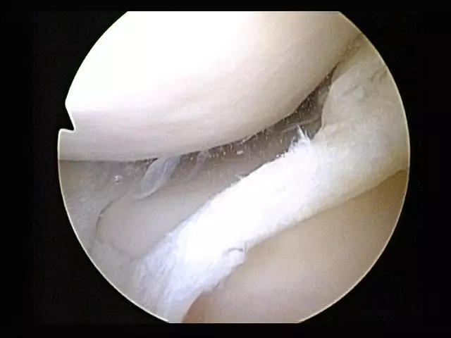 A new type of stem-cell-seeded bandage, designed to heal torn meniscal cartilage such as that pictured above, has been approved for a clinical trial in the UK (Photo: Arthroscopist)