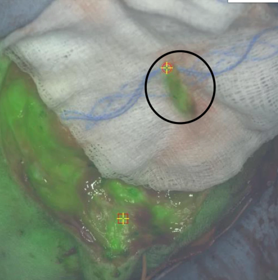 A dye has been used to illuminate both a primary breast cancer tumor in dogs, as well as lymph nodes where the disease had spread