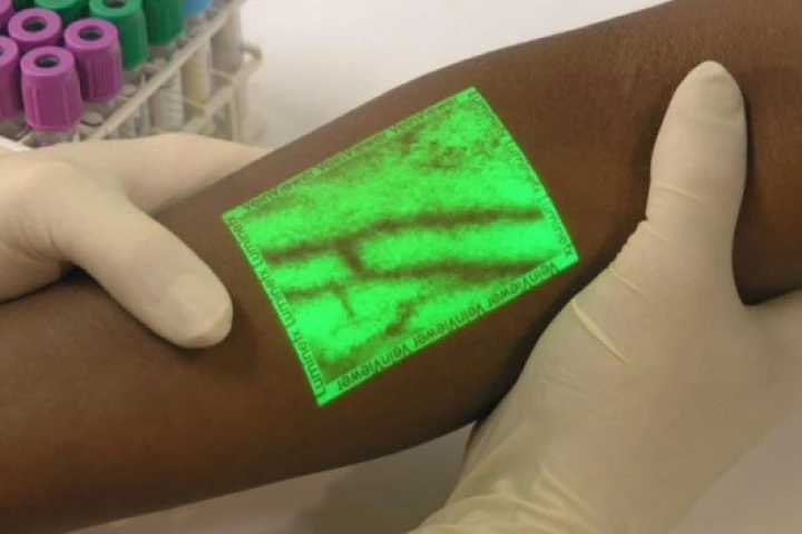 Real-time image of underlying vasculature as seen on the surface of the skin with VeinViewer by Luminetx.