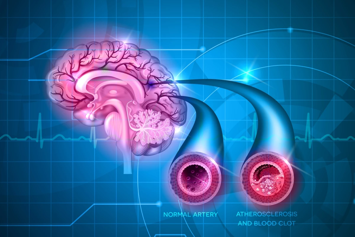 New research paves the way for a blood test that can detect whether someone has suffered a minor stroke