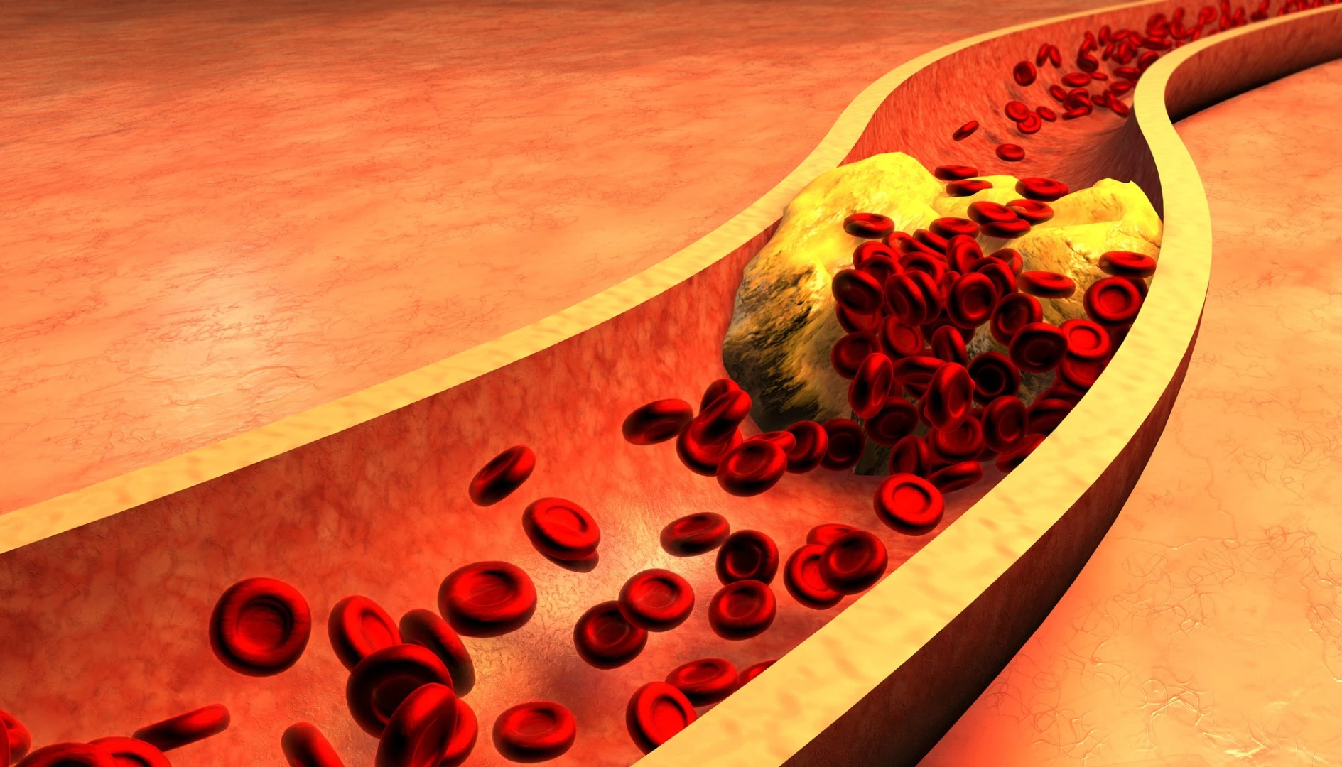The Pantheris system can not only spot blockages in blood vessels, but it can help doctors shave them away as well