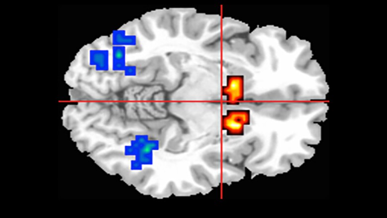 Through MRI scans, cannabidiol was found to reduce abnormal brain activity in people showing psychosis symptoms