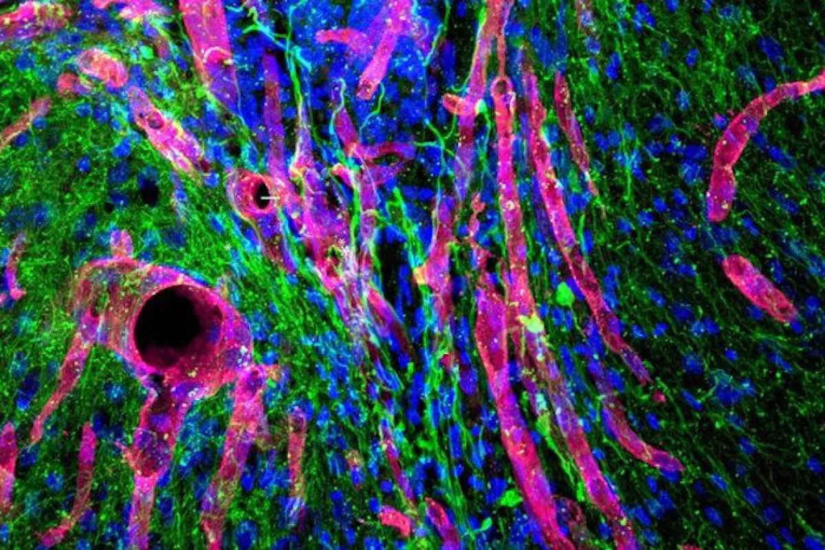 A photomicrograph of the new tissue grown in the stroke-damaged cavity of a mouse brain: the red tubes are blood vessels while the green sections are nerve fibers