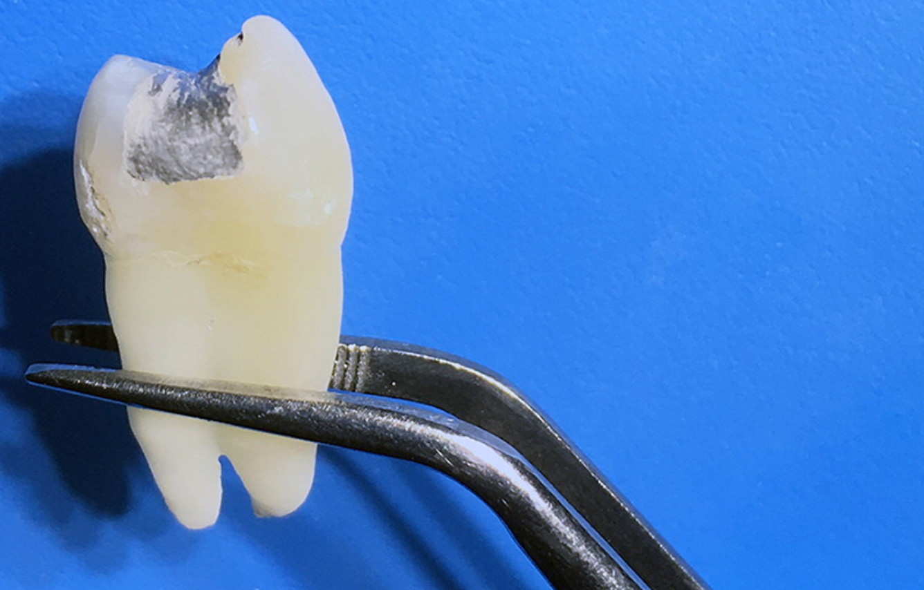 New MRIs are so strong, they could cause mercury to leak from your teeth