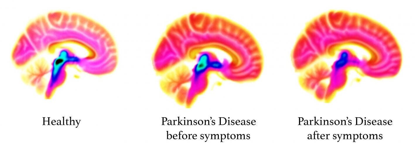 Brain imaging showing early signs of Parkinson's in pre-symptomatic patients