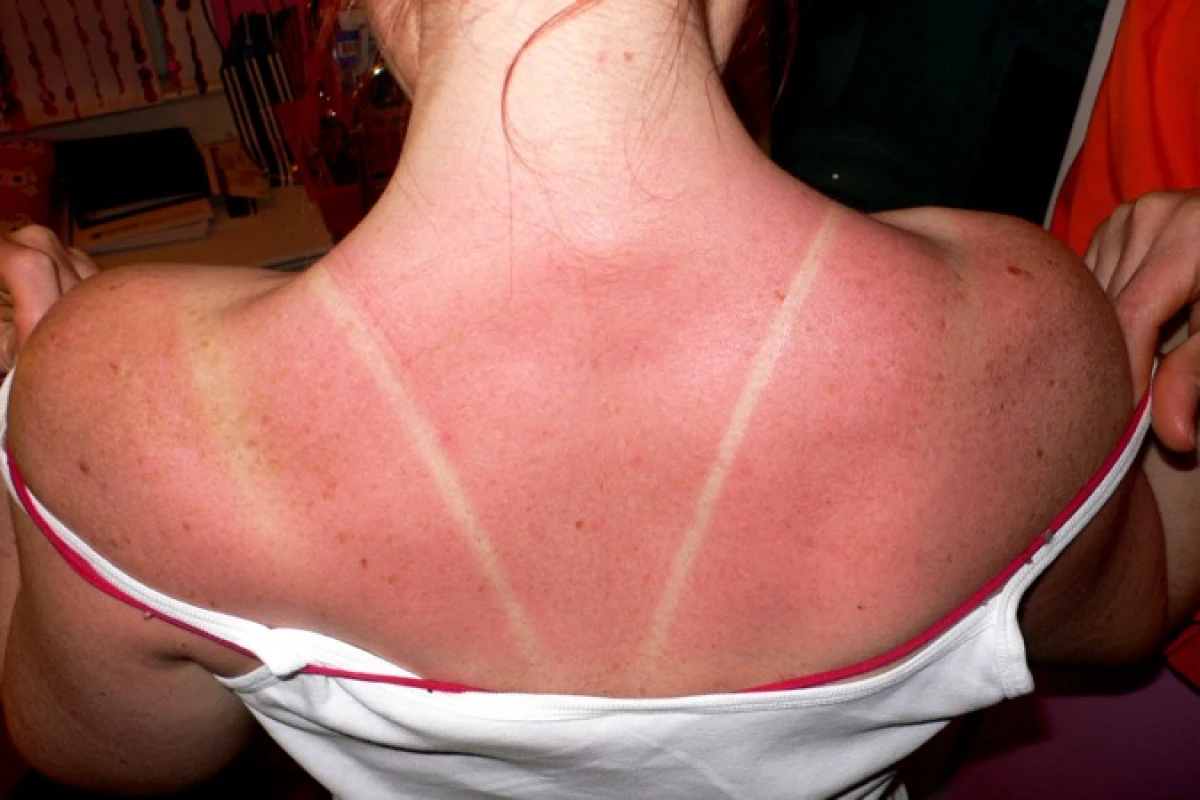 A new understanding of the workings of a DNA-repairing enzyme could lead to medications that heal sunburns (Photo: Kelly Sue DeConnick)