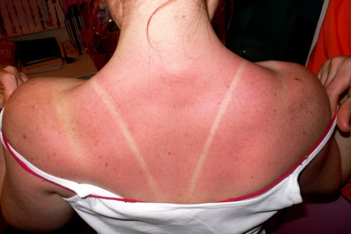 A new understanding of the workings of a DNA-repairing enzyme could lead to medications that heal sunburns (Photo: Kelly Sue DeConnick)