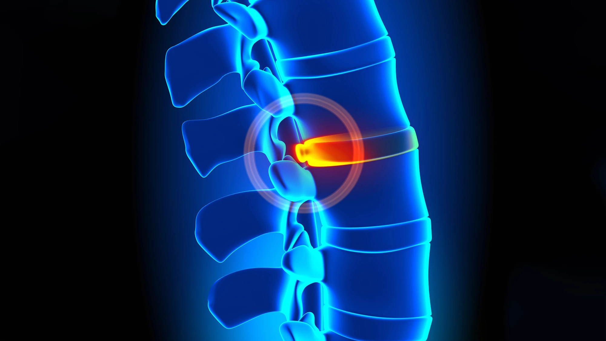 A minimally invasive procedure effectively treated low back pain caused by degenerated discs