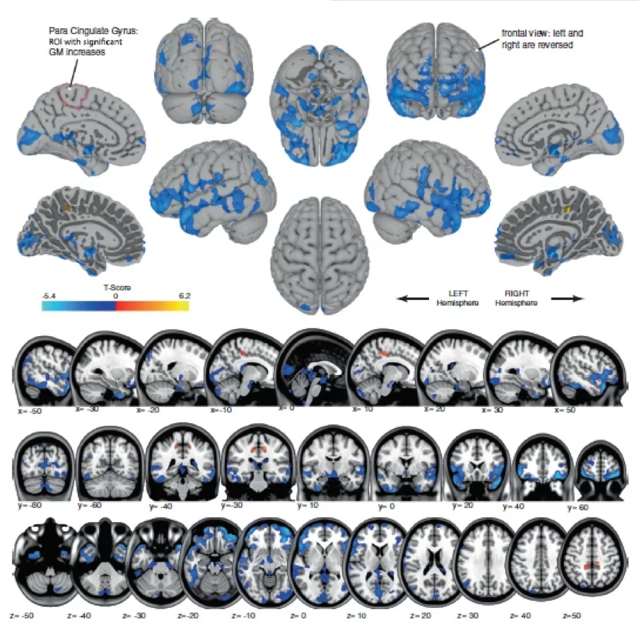 The blue sections highlight where gray matter decreased, while the orange areas show where its volume increased