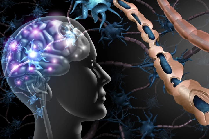 The body's own polysialic acid may be key in flipping the switch on MS inflammation and nerve damage