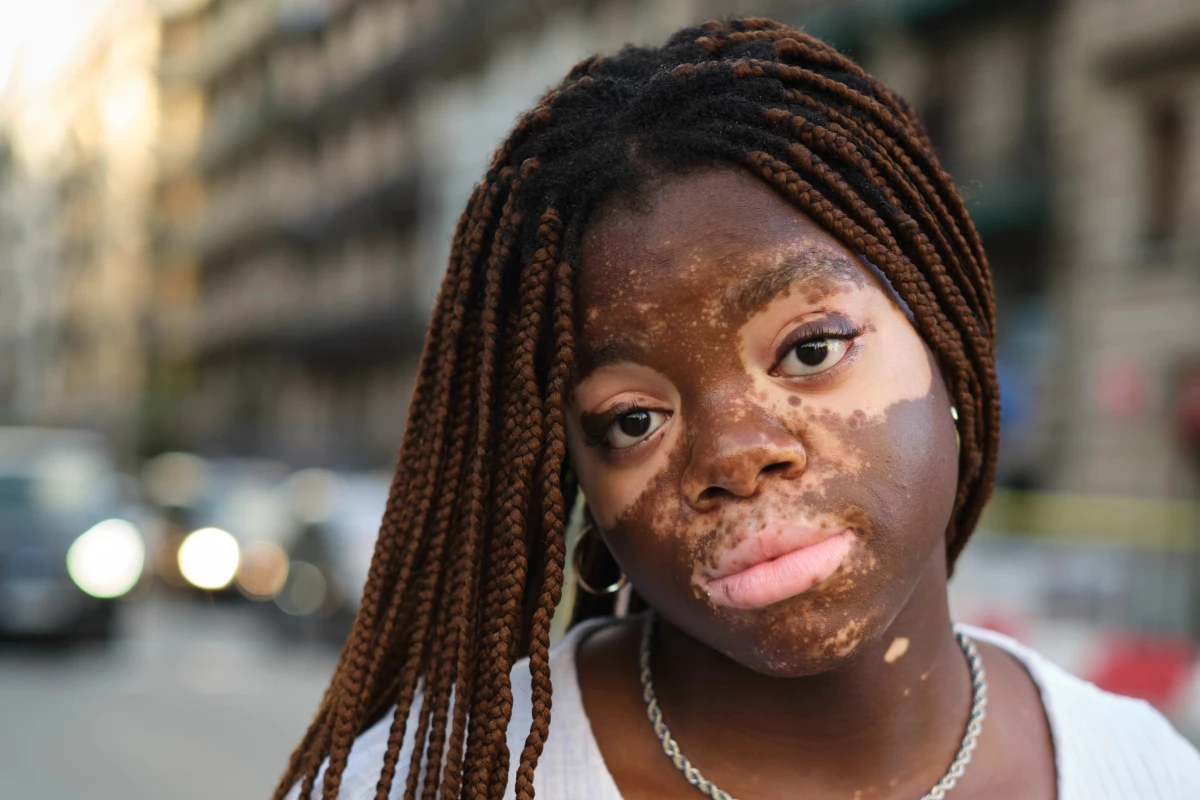 Although vitiligo isn't dangerous, it can be the source of substantial emotional distress