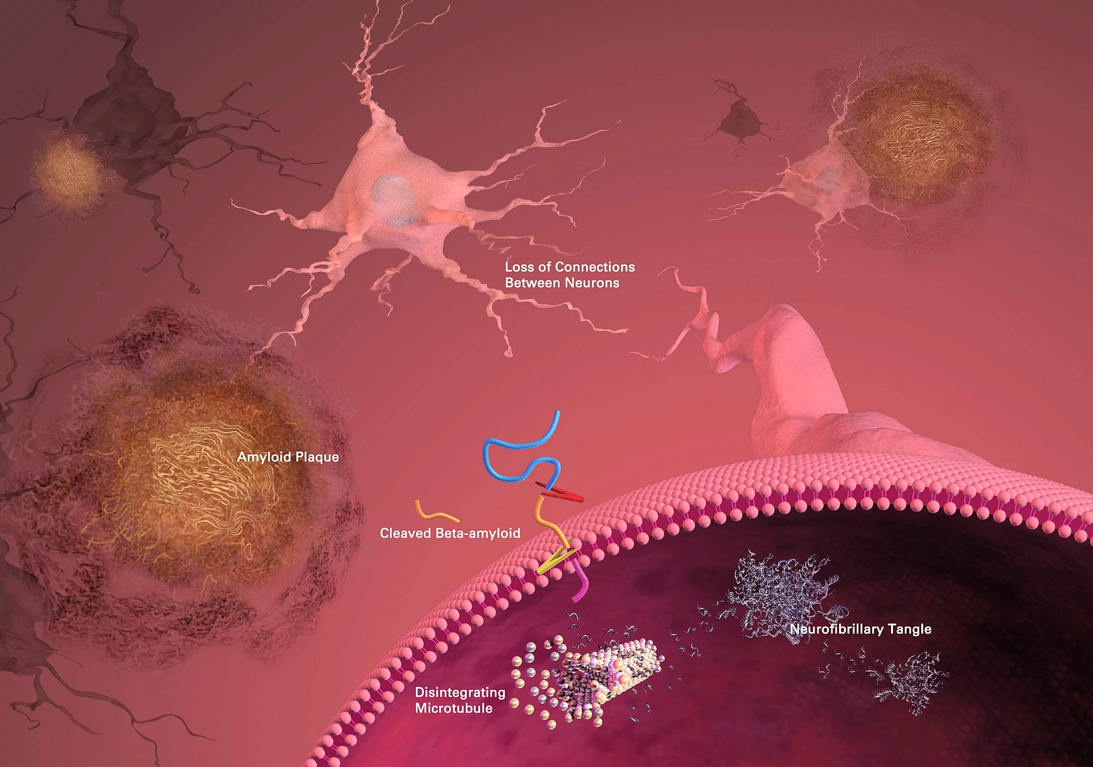 Formation of beta amyloid plaques that interfere with communication paths between neurons in the brain of an Alzheimer's patient (Photo: National Institute on Aging)