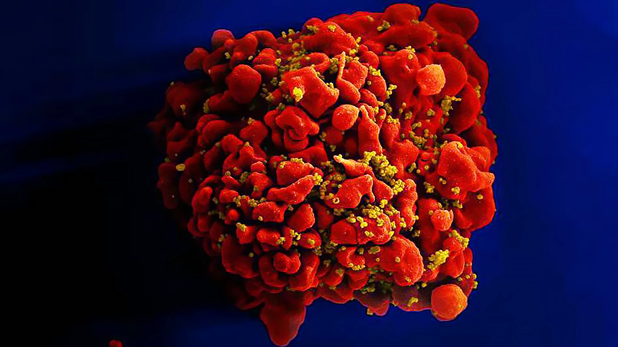 Scientists now know how HIV (the tiny yellow particles seen here) integrates into the human genome