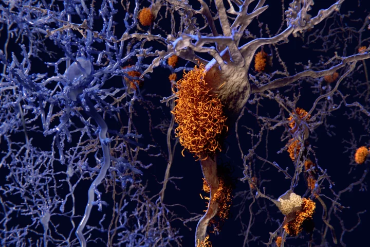 Research suggests toxic amyloid and tau proteins can change their molecular shape to avoid detection and removal by the body's cellular garbage disposal system