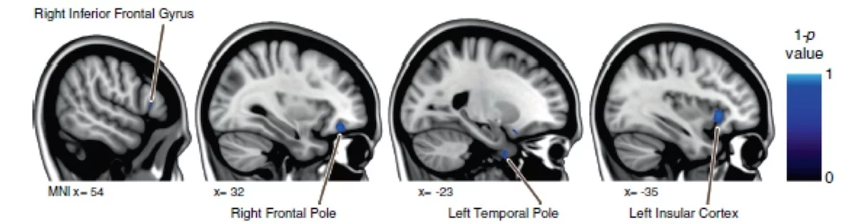 Changes to an astronaut's gray matter were more marked the more time they spent in space: the blue areas represent the areas of the brain that showed further decreases in gray matter as a result of a longer stay