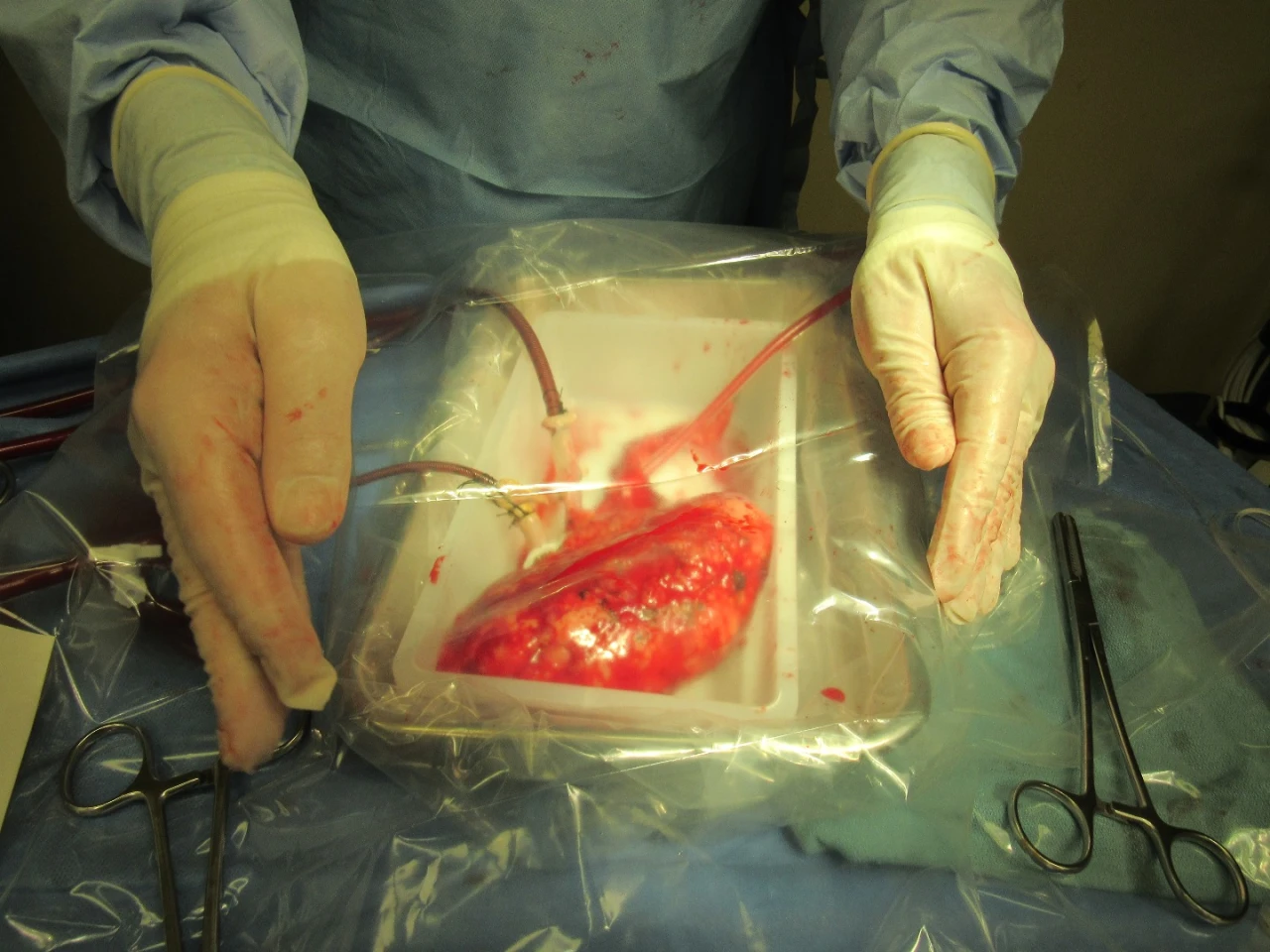A converted heart-lung bypass machine pumps a warm mixture of blood, nutrients, minerals, amino acids, oxygen, glucose, antibiotics and drugs through the extended criteria kidney