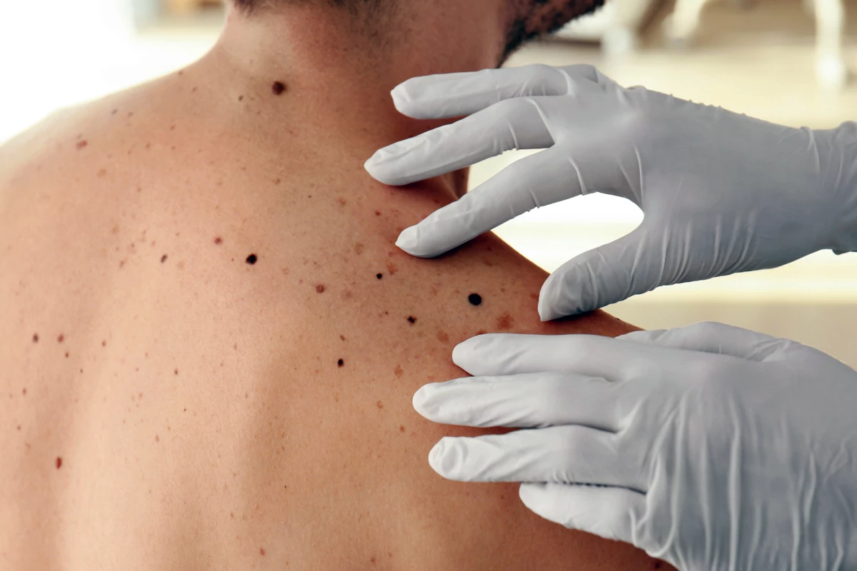 New research challenges the idea that melanoma is not generally caused by genetics