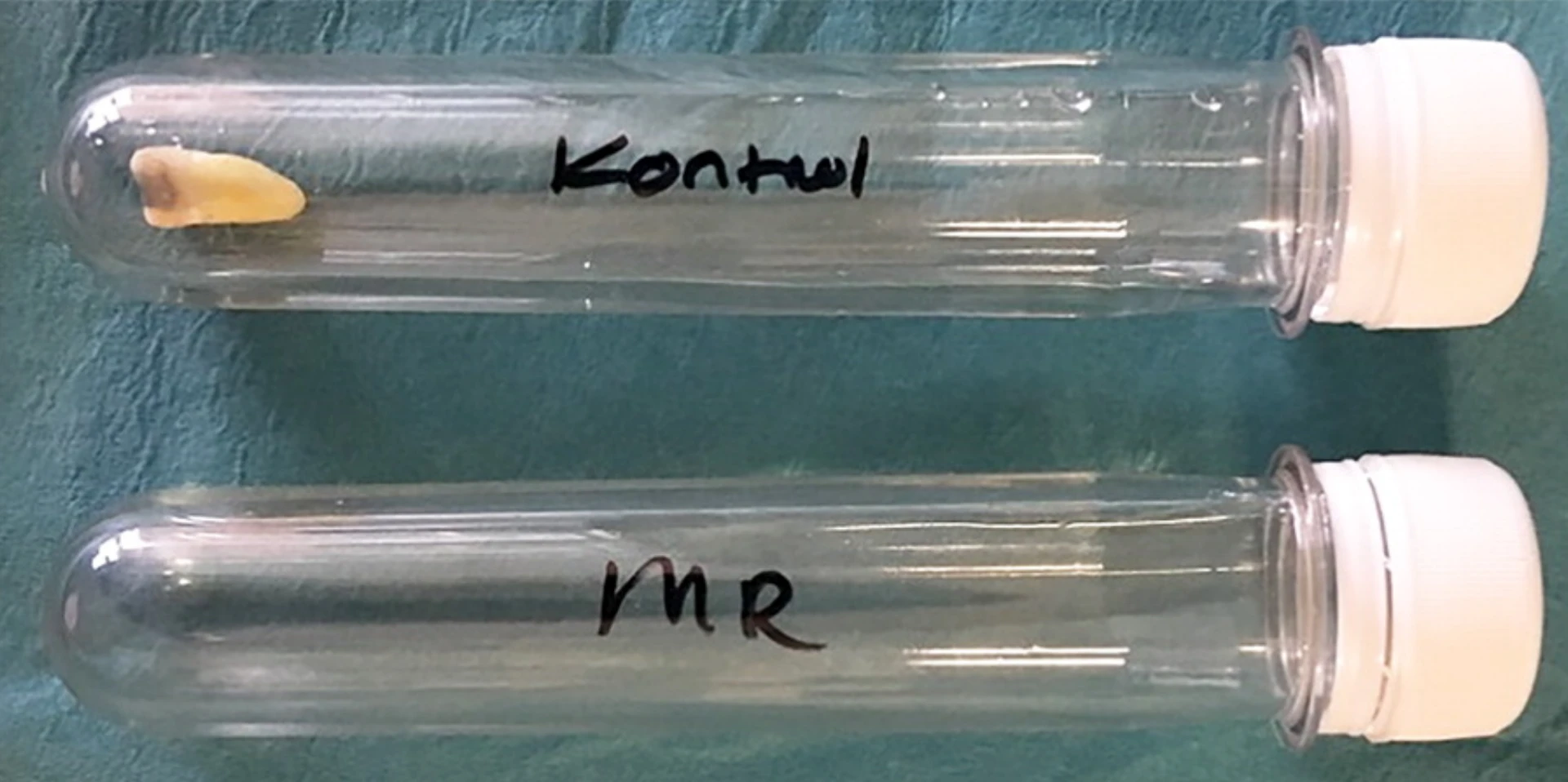 Sample tubes containing, top, tooth with dental amalgam in artificial saliva in preparation for testing and, bottom, artificial saliva only. Tube had previously undergone MRI, and the tooth was removed 24 hours after imaging