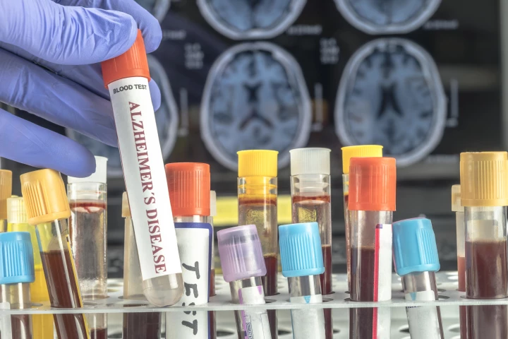Alzheimer's diagnosis is set to become easier and less invasive