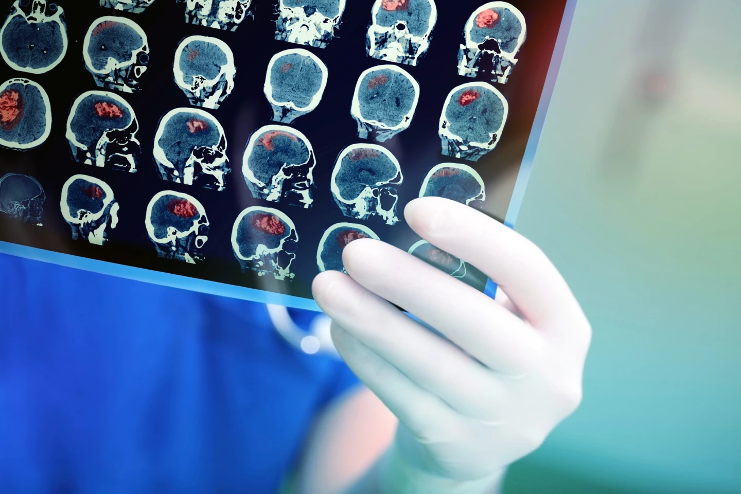 DMT has the potential to become a groundbreaking new stroke treatment