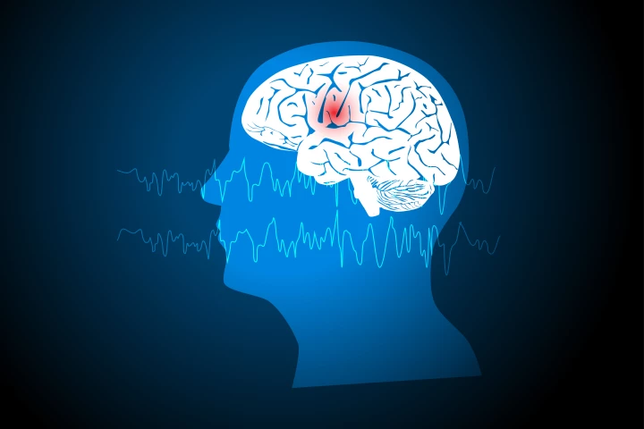 Adults with drug-resistant focal onset seizures are the target of experimental epilepsy drug RAP-219