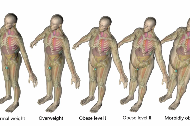 VirtualDose utilizes computer models of different body types to advise physicians on which CT scanning configurations will produce the least amount of radiation