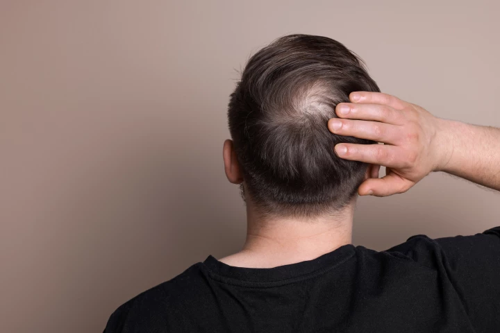 This drug has been in the pipeline since 2021, and could soon get FDA approval for treating pattern hair loss
