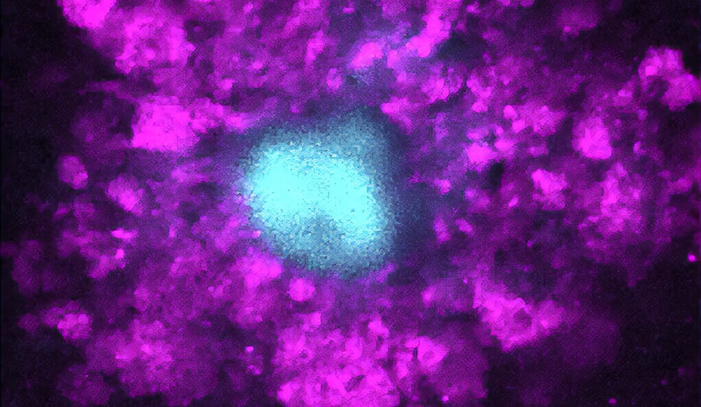 A microscope image of amyloid plaques (blue) surrounded by swelling in axons (purple)