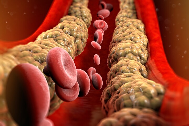 A groundbreaking oral drug has been developed that lowers lipoprotein(a), a previously untreatable largely inherited form of 'bad cholesterol'