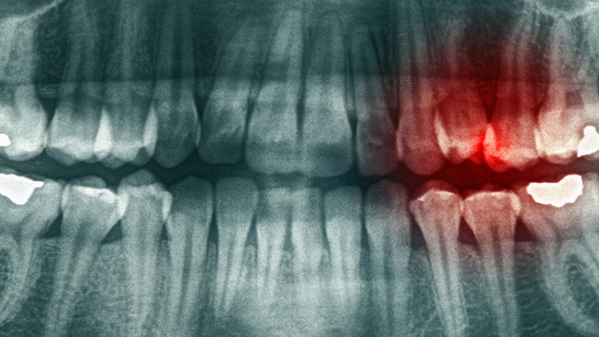 Combining exercise and omega-3 supplements reduced tooth infection severity