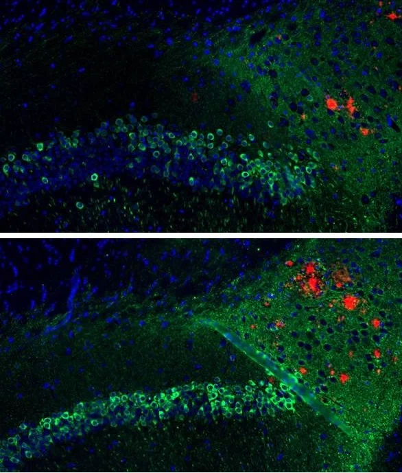 Top: A DNA vaccine given to a mouse modeled to have Alzheimer’s disease reduced beta-amyloid plaques (red) and tau tangles (green) in the hippocampus region of the brain. Bottom: An untreated mouse modeled to have Alzheimer’s disease accumulated notably more beta-amyloid plaques (red) and tau tangles (green) in the hippocampus region of the brain
