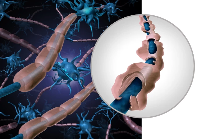 Multiple sclerosis is an autoimmune disease where the immune system mistakenly attacks the protective myelin coating on neurons